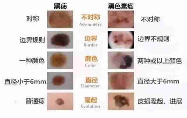 切痣，看这一篇就够了