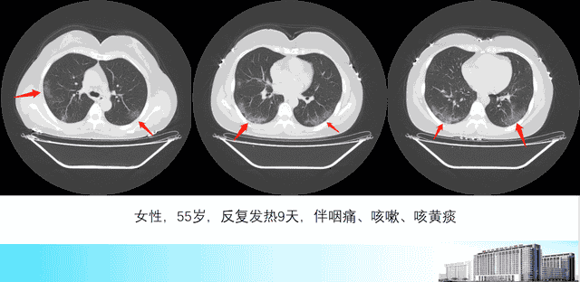 新冠肺炎的3种吸收方式，医生教您看CT