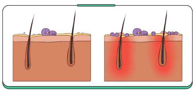 痤疮or毛囊炎？孩子身上这种痘到底是啥？一张图帮你分辨