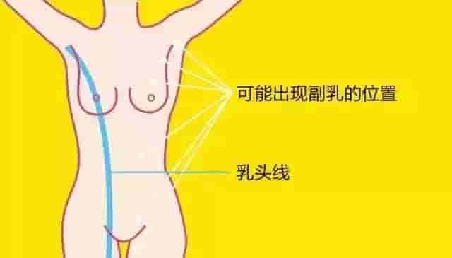 副乳你不当回事！！非要等到乳腺癌、淋巴癌吗？