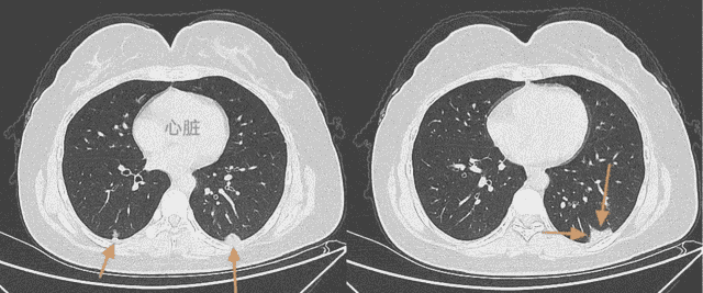 新冠肺炎的3种吸收方式，医生教您看CT