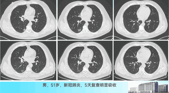 新冠肺炎的3种吸收方式，医生教您看CT