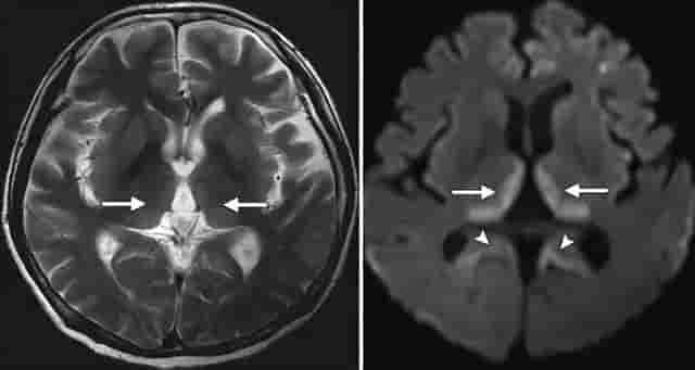 人吃人的天罚 20号染色体 来自人类祖先 基因中的“罪恶”？