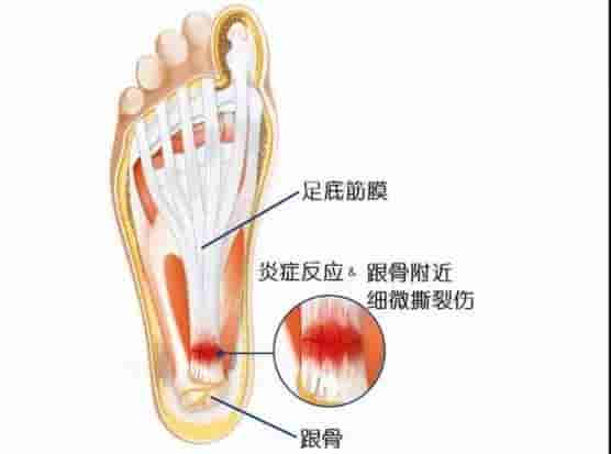 什么是足底筋膜炎？该如何预防？