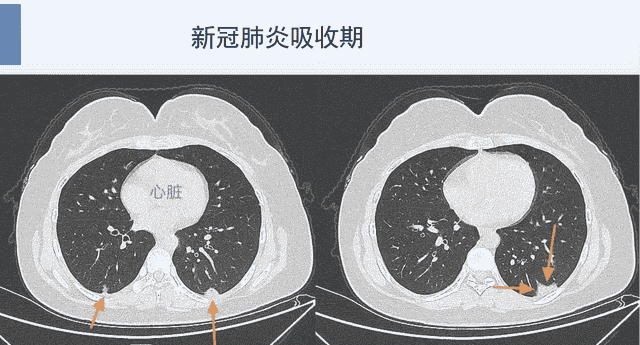 新冠肺炎的3种吸收方式，医生教您看CT