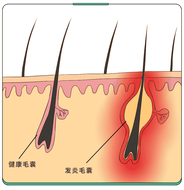 痤疮or毛囊炎？孩子身上这种痘到底是啥？一张图帮你分辨