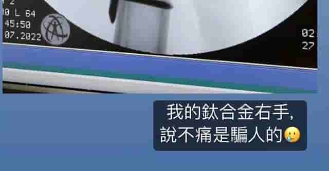 林志颖首次公开X光片，右臂打10根钉子忍痛做复健：不疼是骗人的