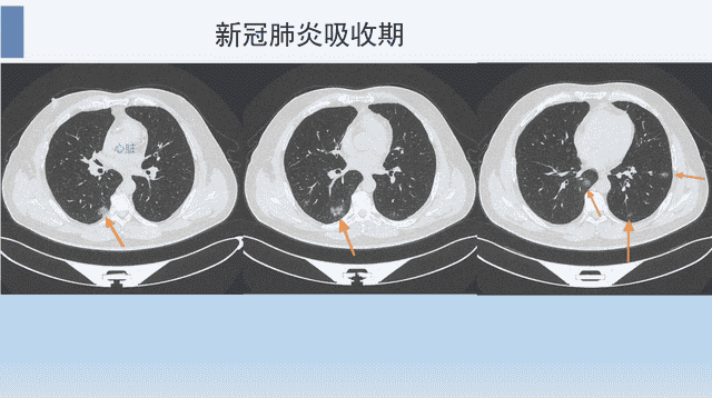 新冠肺炎的3种吸收方式，医生教您看CT