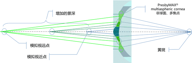 神操作！既近视又老花，激光手术一次性解决