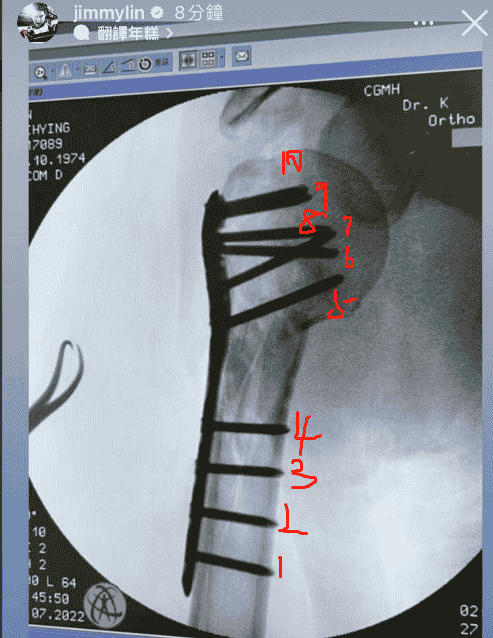 林志颖首次公开X光片，右臂打10根钉子忍痛做复健：不疼是骗人的