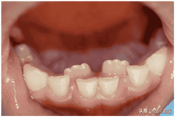 1岁娃才长出4颗牙，就全都烂掉！华西口腔邹静教授：可能妈妈孕期缺营养
