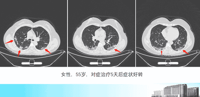 新冠肺炎的3种吸收方式，医生教您看CT