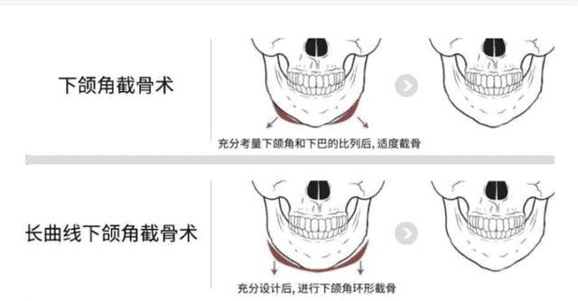 「韦敏科普」想要改善下颌角都有哪些项目？