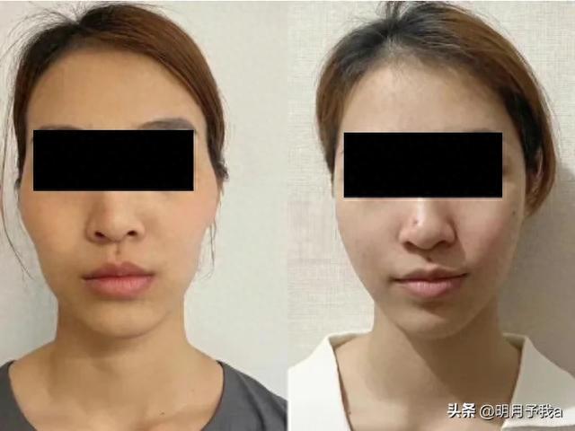 女子过海关双腿绑满少女针，用裙子遮掩