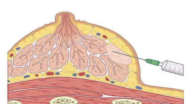 乳腺癌筛查后医生建议穿刺活检，乳腺穿刺活检怎样做？是否安全？