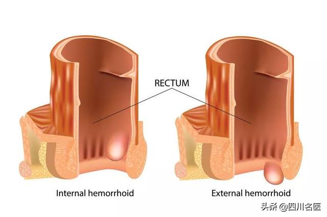 你为什么会长痔疮？医生：4大高危因素你占几个？现在改还来得及