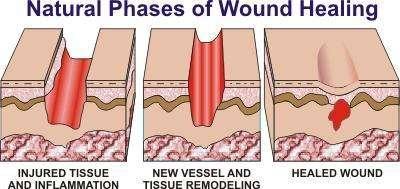 创面愈合的类型及临床治疗