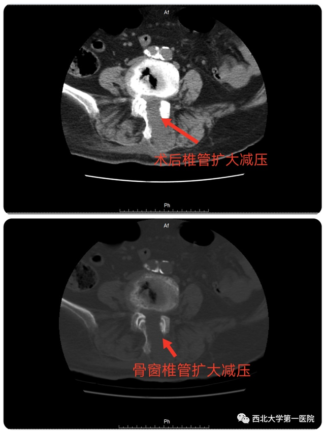 一个小孔治疗腰椎管狭窄，西北大学第一医院骨三科成功开展OSE脊柱内镜手术