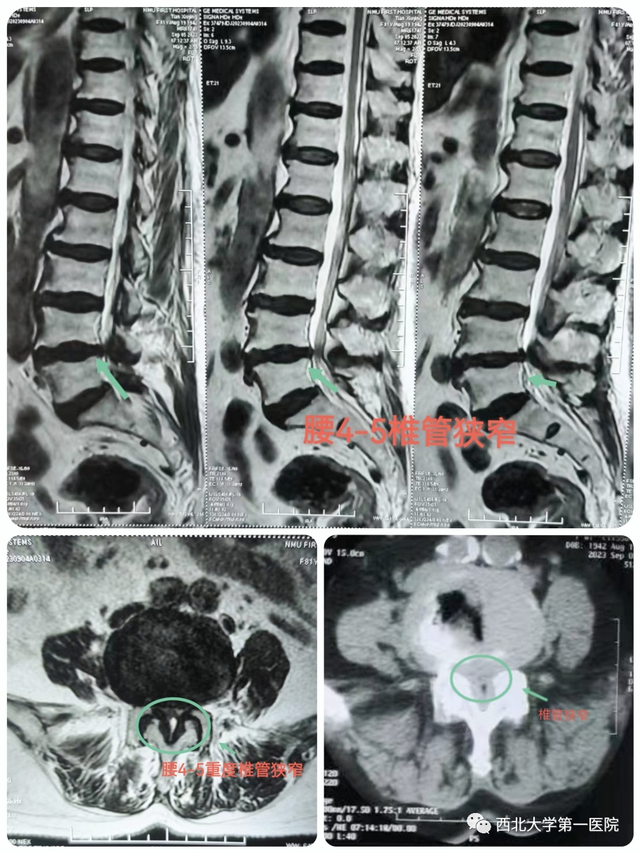 一个小孔治疗腰椎管狭窄，西北大学第一医院骨三科成功开展OSE脊柱内镜手术