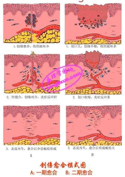 创面愈合的类型及临床治疗