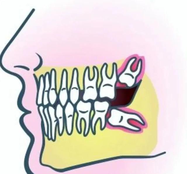 如果你害怕拔智齿，一定要看完这篇→