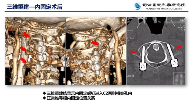 女子车祸手术后突然死亡，法医穿透迷雾，用虚拟解剖揭开真相